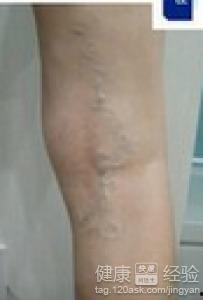 成人静脉曲张游戏视频大全,游戏视频大全带你轻松了解